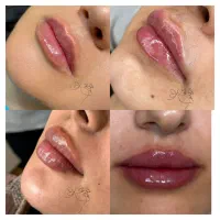 لیزرموهای زائد،فیلروبوتاکس،هایفو