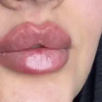 تزریق ژل و بوتاکس فقط ۲۳۰ تومن