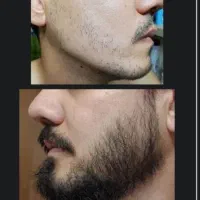رویش. طبیعی ریش. 1ماهه.