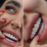 اموزش صفر تا صد کامپوزیت دندان