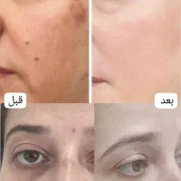 کرم ضدلک جهانی و فوق العاده قوی(جایگزین لیزر)