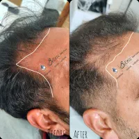رویش مجدد مو ۱۰۰ درصد تضمین بازگشت وجه