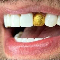 ایمپلنت کامپوزیت لمینیت اقساط با کد ملی از دم قسط