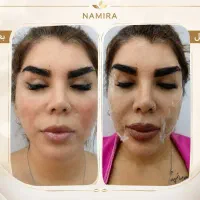 خدمات زیبایی،لیفت نخ کاگ وژل لب پینترستی(آفر ویژه)