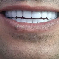 ساخت انواع دست دندان‌های  ژله‌ای طرح کامپوزیت