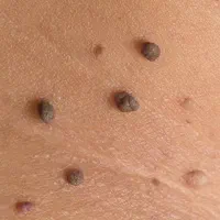 لیزر زیگیل تناسلی و خال گوشتی درمنزل