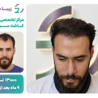 کاشت مو به روش fit با برداشت لیزری با تخفیف ویژه