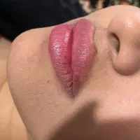 فیلر،مزوژل،بوتاکس