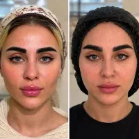 فیلر /جوانسازی/ اصلاح فرم چهره/کانتورینگ