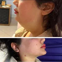 پیکرتراشی و ژنیکوماستی مردان و ماموپلاستی