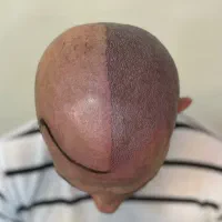 میکرواسکالپ سر ( پوشش کچلی )