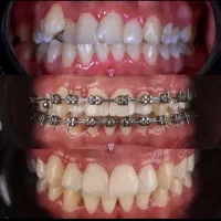 دندانپزشکی ـ کامپوزیت ـ زیبایی ـ 20٪ تخفیف ویژه ـ