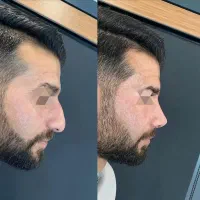 جشنواره تابستانه عمل بینی