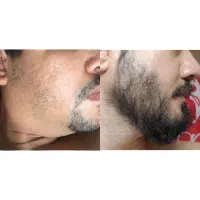 رویش پرپشتی ریش و سبیل