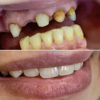 دندانپزشکی،روکش،بریج،لمینت،دندان مصنوعی
