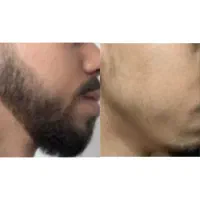 پایان ریزش شروع دوباره