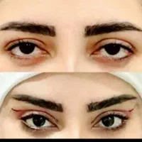 جشنواره جراحی پلک سانترال لب دایرکت ابرو
