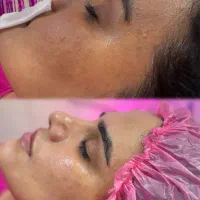 روشن سازی جوانسازی لیفتینگ رفع چین وچروک