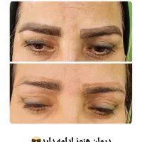 لیزر جای جوش،رگ عروقی،پاک کردن تتو،فیلر،بوتاکس
