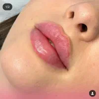 جشنواره تزریق ژل، بوتاکس، چربی و ساکشن غبغب