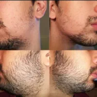 ریشات سپر کن