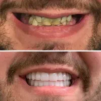 دندان ایمپلنت کره ای با ضمانت 11تومن