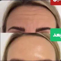 کرم 5 کاره بیوممتیک / جایگزین بوتاکس
