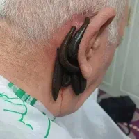 حجامت کبد فصد خون  واریس مزاج شناسی زالو درمانی