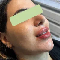 فیلرلب/ژل لب/توسط پزشک/انواع مدل ژل لب