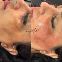 حذف دائمی لک و کک مک گلسار کلینیک