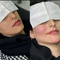 تخفیف ویژه ژل و بوتاکس و اموزش