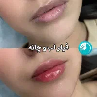 ژل و بوتاکس