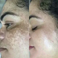 کرم جوانساز و ضد لک قوی(از بین برنده جوش)