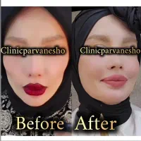 ژل بوتاکس مزوتراپی