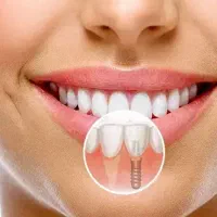 ایمپلنت دندان تضمینی اقساطی