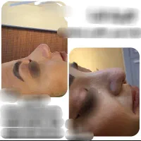 بوتاکس ژل لیفت نخ جراحی پلک چربی پی آرپی اندولیفت|خدمات زیبایی و سلامت|اصفهان, مولوی|دیوار