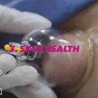 ماساژحجامت بادکش