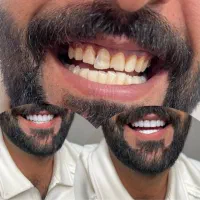 کامپوزیت دندان