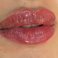 ژل و بوتاکس