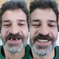 لابراتوار دندانسازی اهورا،دندان مصنوعی