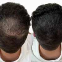 میکرو اسکالپ سر، کاشت مو غیر تهاجمی،رویش مجددمو