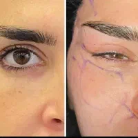 بلفاروپلاستی آلمانی جراحی پلک لیفت ابرو لیفت شقیقه