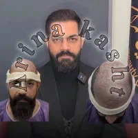 جشنواره کاشت مو فول تراکم تضمین کیفیت تخفیف همدلی