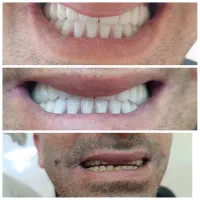 ساخت دندان های مصنوعی متحرک