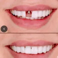 مرکز فوق تخصصی ایمپلنت دیجیتال مشهد سبک کاخ لبخند