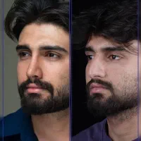 جراحی بینی با قیمت پارسال + اقساط + مشاور رایگان