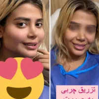 تزریق چربی و ساکشن