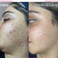 جشنواره پاکسازی پوست اسفند