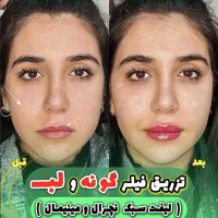 تزریق بوتاکس فیلر ژل پی آر پی نخ لیفت صورت بینی