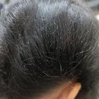 پاکسازی شپش در یک جلسه